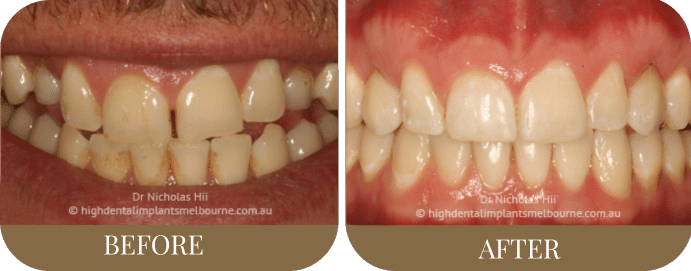 Clear aligners, fillings and AirFlow