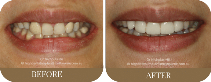 Crowns and porcelain veneers (3)