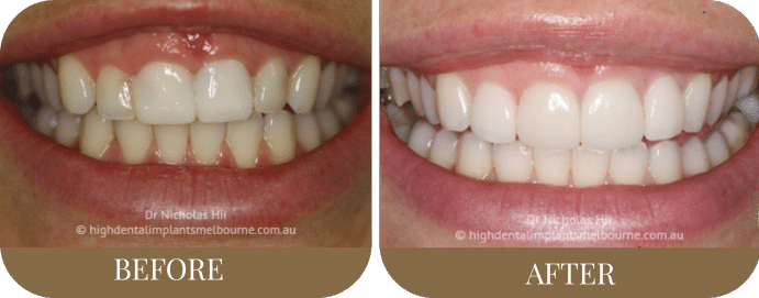 Crowns and porcelain veneers