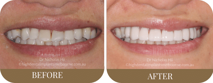 Crowns, porcelain veneers and an implant