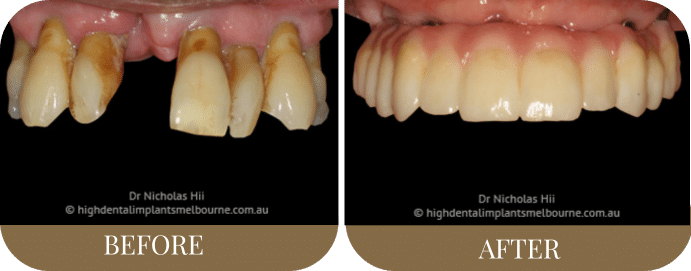 Full upper arch implants