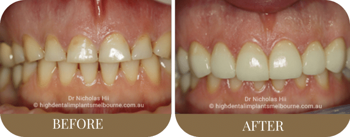 Porcelain veneers (2)