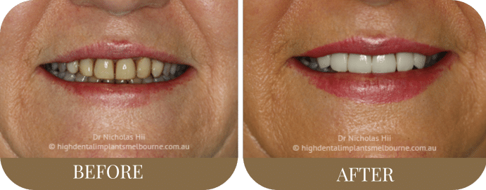 Porcelain veneers (3)