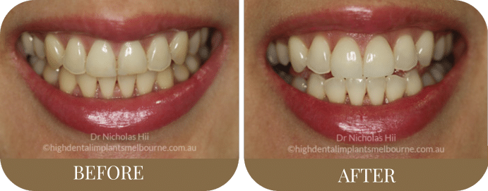 Porcelain veneers (4)