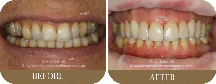 Porcelain veneers