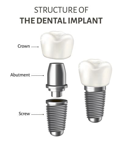Structure of Dental Implants Single Tooth