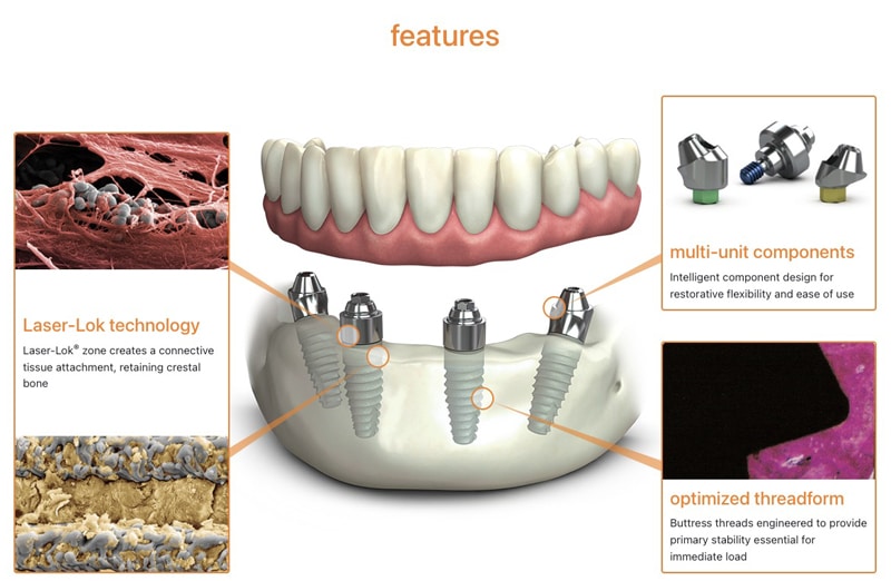 TeethXpress Implants Cost