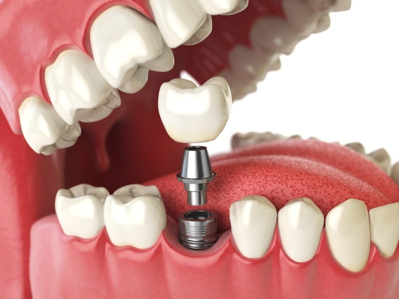 How to Clean All-On-4 Dental Implants Safely and Effectively?