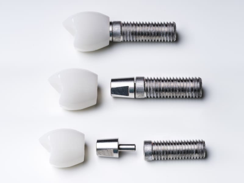What to Know Before Getting New Dental Implants?