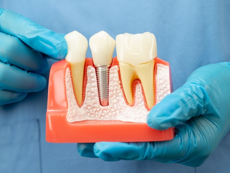 Why Should You Avoid Dairy After a Dental Implant?