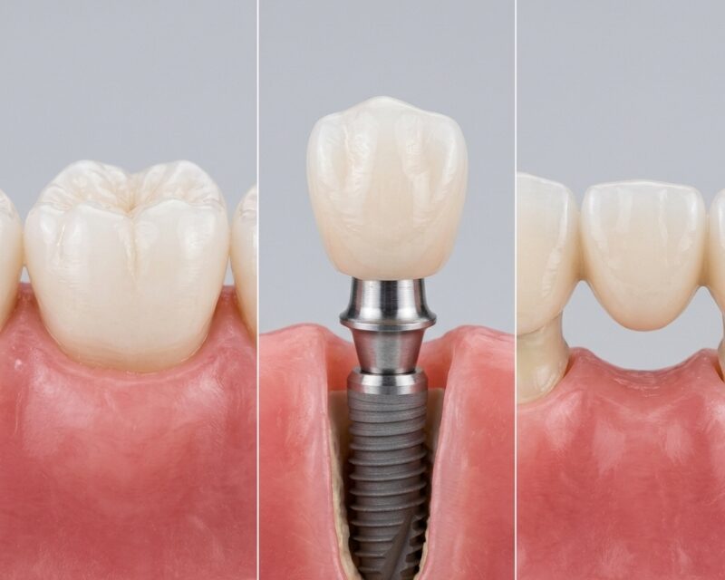 How Replacing Missing Teeth Improves Oral Health, Comfort and Confidence