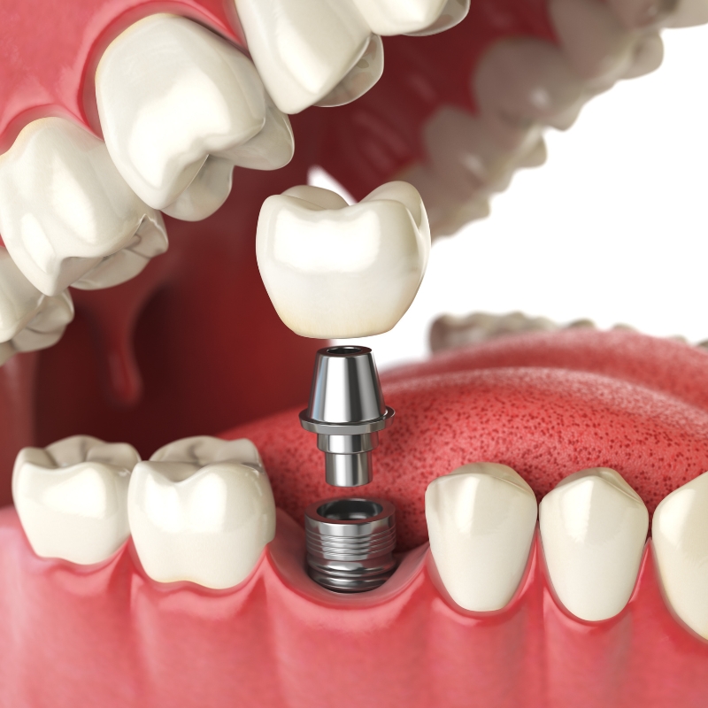 3D diagram showing how tooth implants connect a metal post, abutment, and ceramic crown in the lower jaw.