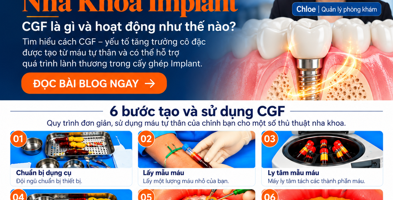 CGF Trong Nha Khoa Là Gì? Vai Trò Của CGF Trong Cấy Ghép Implant